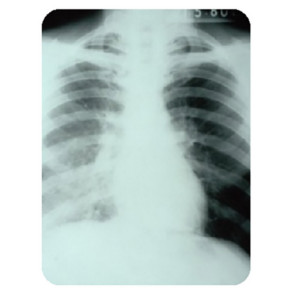 Un polmone infetto da legionella